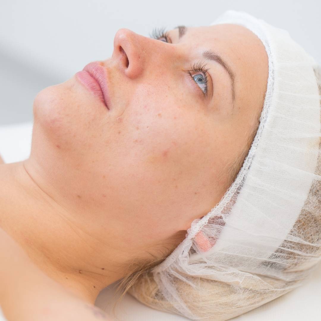 laser acne removal #1