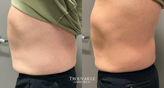 Emsculpt Before and After
