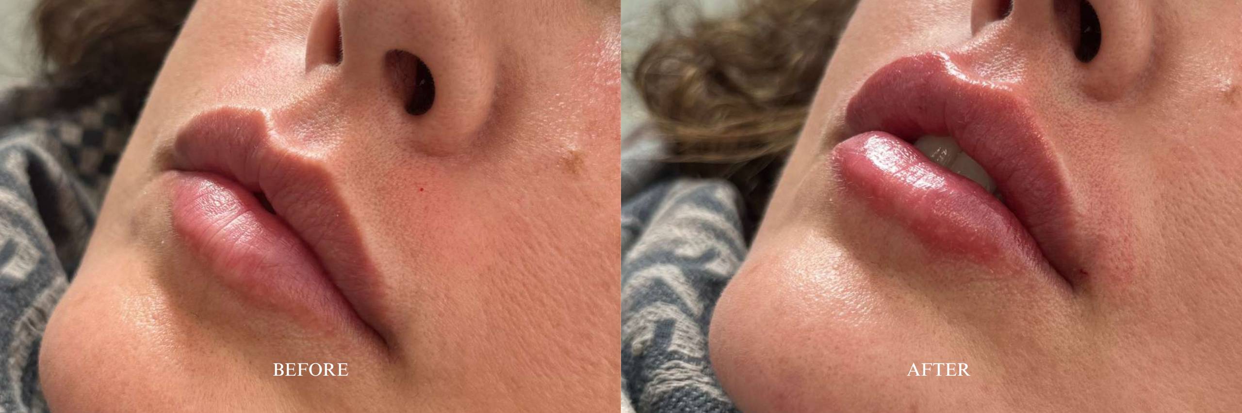 Lip Filler 2 Before and After