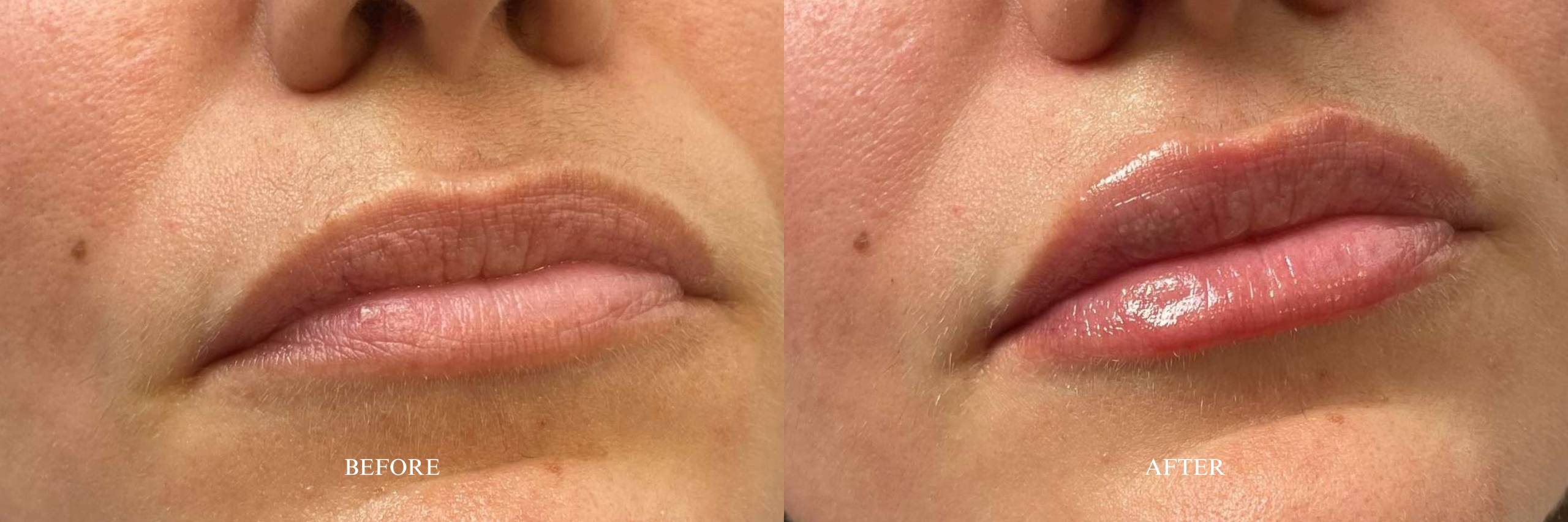 Lip Filler Before and After